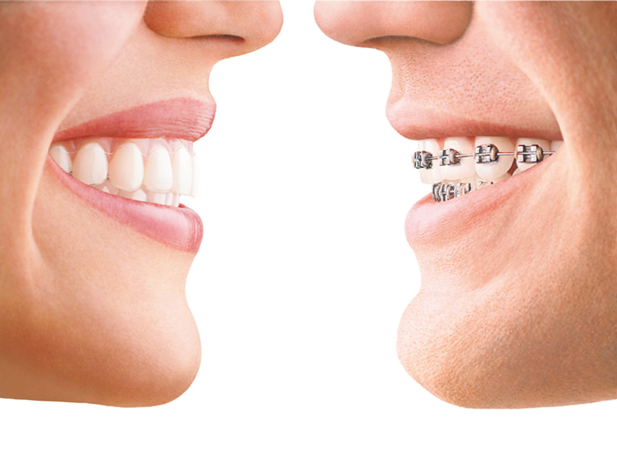 invisalign-comparison.jpg